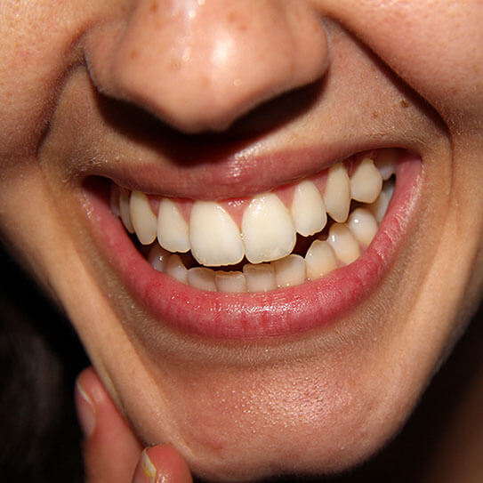 white spots can be treated with teeth whitening