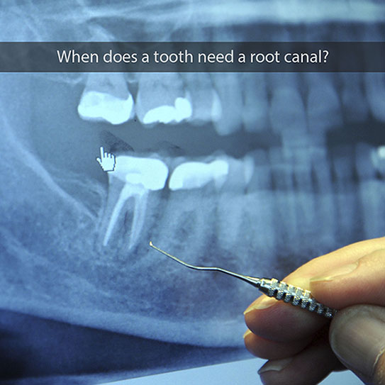 Elevation Endodontics |