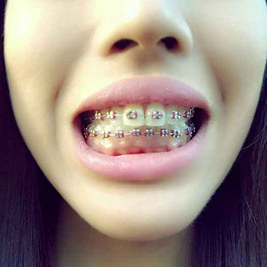 How Do Braces Actually Straighten Teeth?